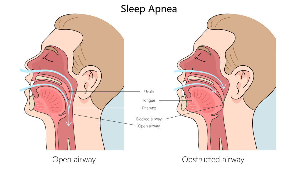 Can Sleep Apnea Kill You?