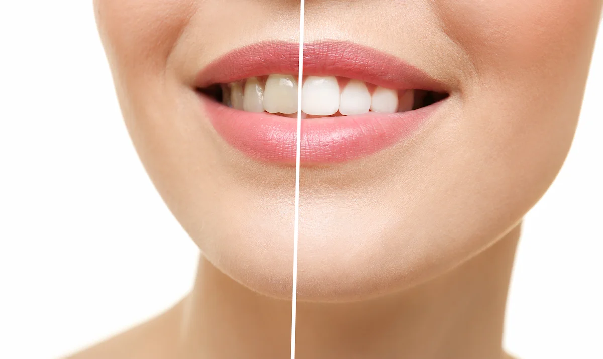 Teeth Whitening: Benefits, Risks, and What to Expect